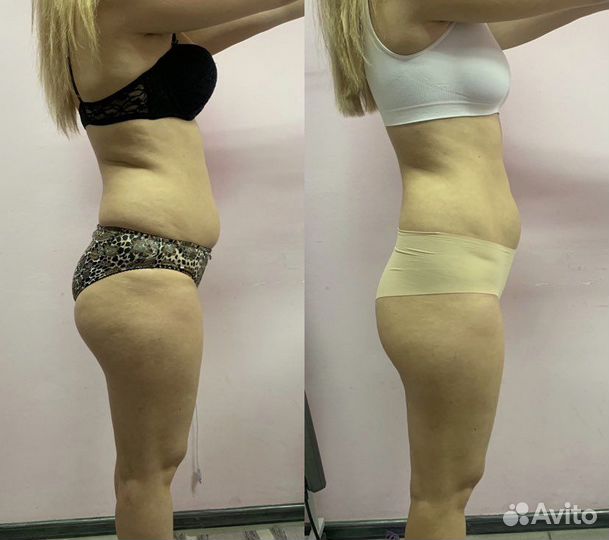 LPG массаж на аппарате B-Flexy