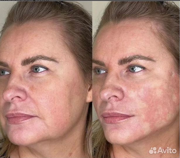 Супер омоложение и подтяжка лица без уколов