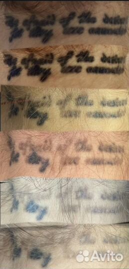 Лазерное удаление тату и татуажа. Ремувер