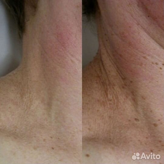 Удаление папиллом