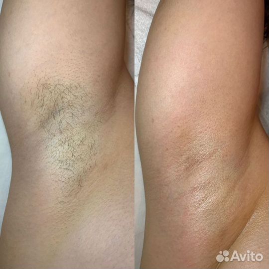 Шугаринг депиляция