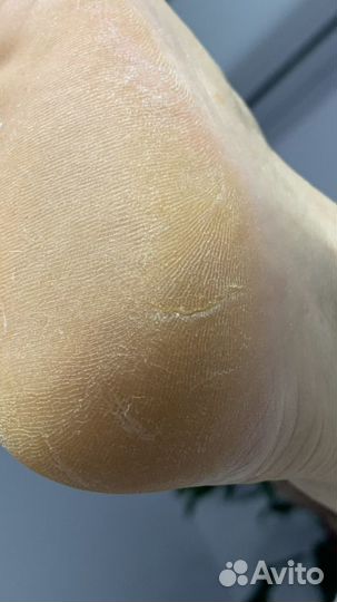 Аппаратный педикюр