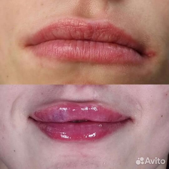 Увеличение губ