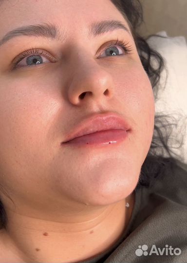 Врач косметолог. Увеличение губ. Ботокс