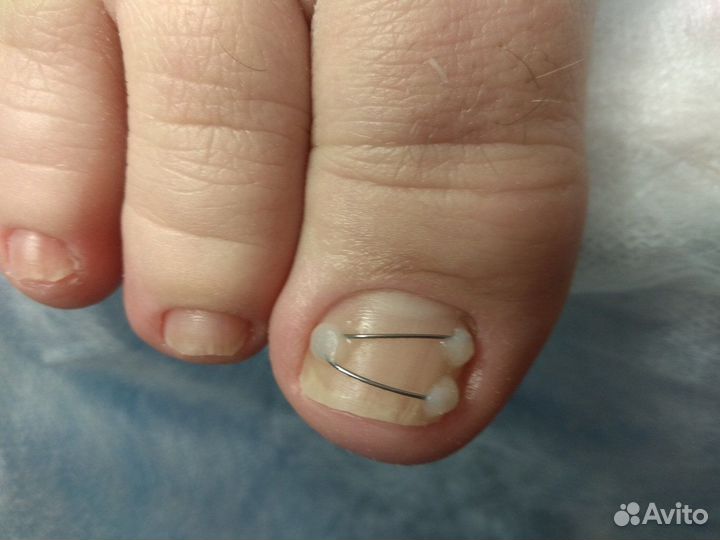 Подолог, коррекция вросшего ногтя, лечение трещин