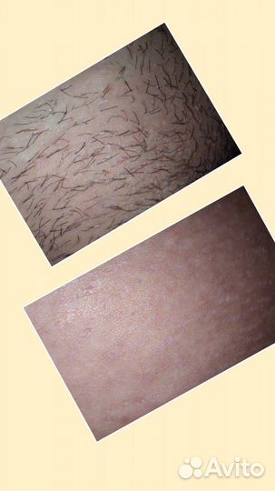 Электроэпиляция