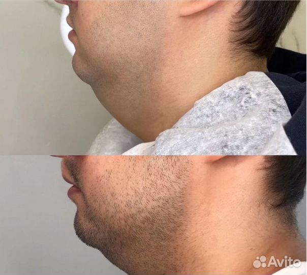 Убираем второй подбородок навсегда. Криолиполиз