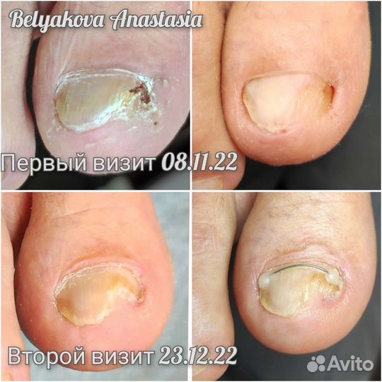 Подолог. Работа со сложными стопами