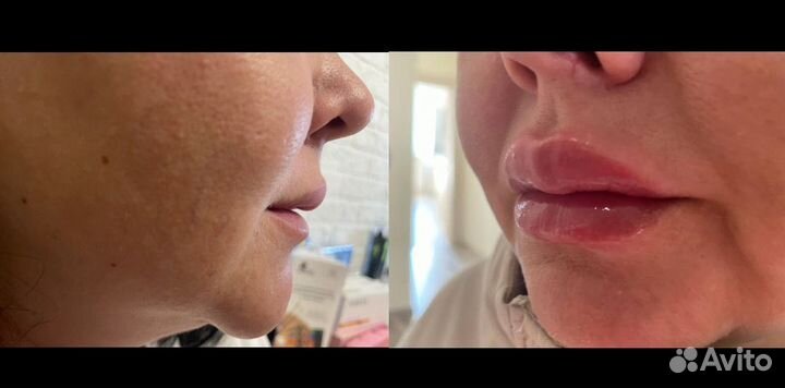 Увеличение губ