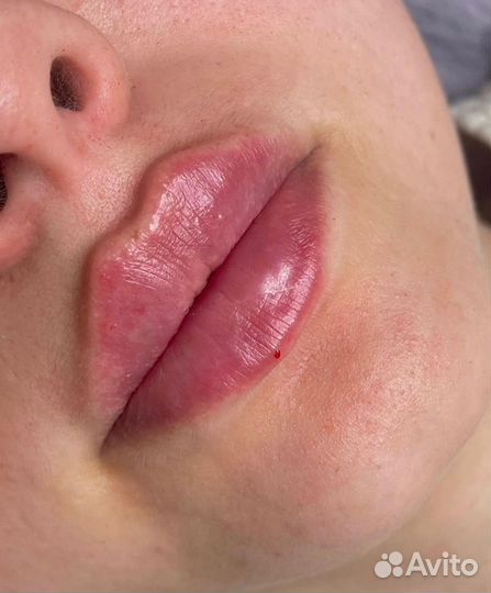 Модель на увеличение губ, контурная пластика