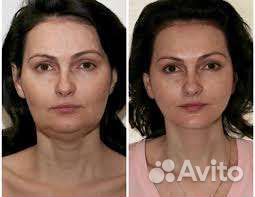 Смас похудение ультраформер smas лифтинг