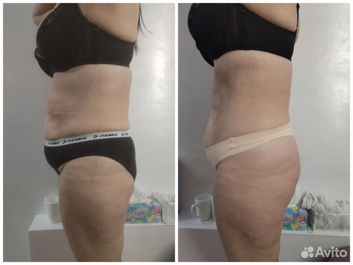 Аппаратный массаж коррекция фигуры