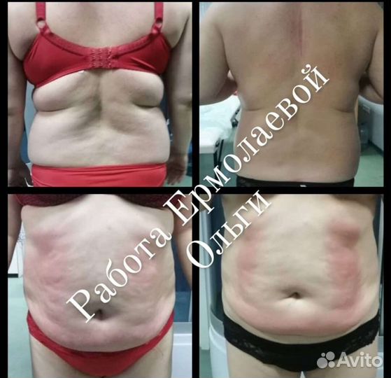 Массаж Антицеллюлитный аппаратный и ручной