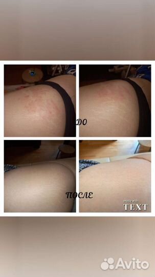 Камуфляж шрамов,растяжек