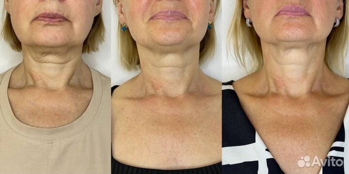 RF-лифтинг (подтяжка)