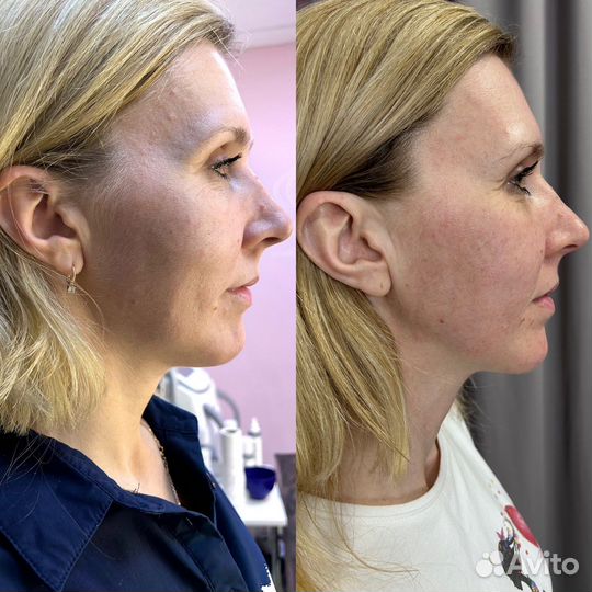Rf лифтинг лица