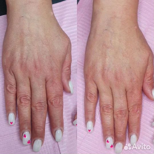 Карбоновый пилинг