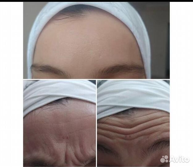 Ботокс для лица
