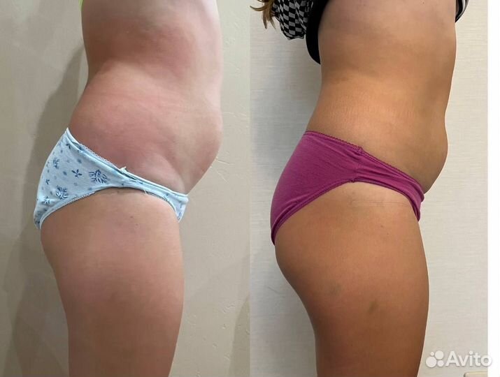 Ультразвуковая Кавитация,быстрое похудение