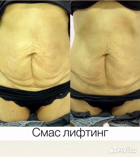 Подтяжка животика, смас лифтинг