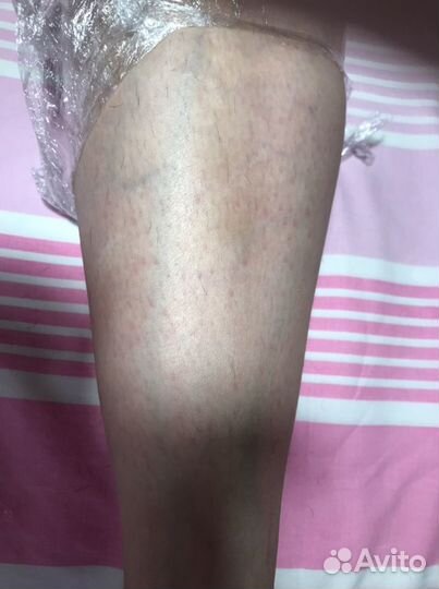 Электроэпиляция