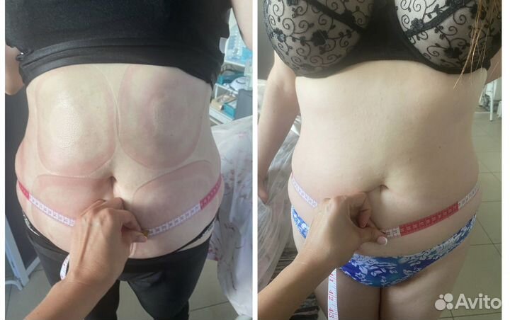 LPG массаж, жиротоп, вибро, антицеллюлитный массаж