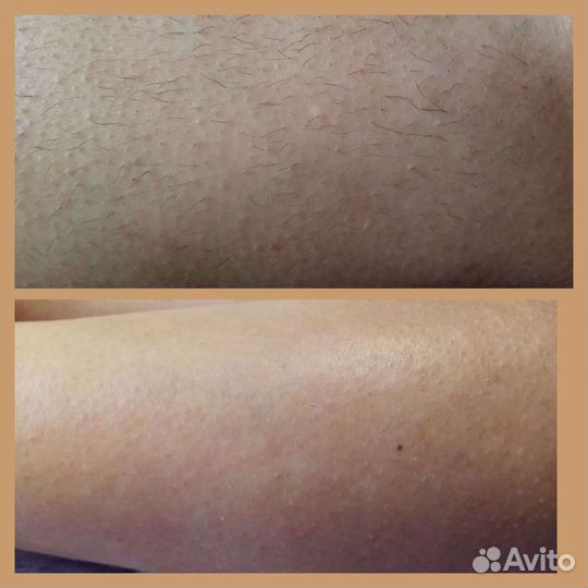 Депиляция шугаринг