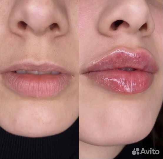 Увеличение губ