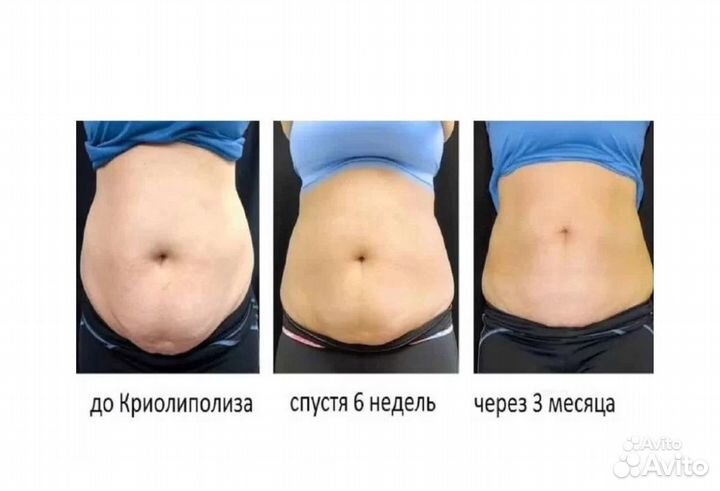 Липосакция без операции в Воронеже