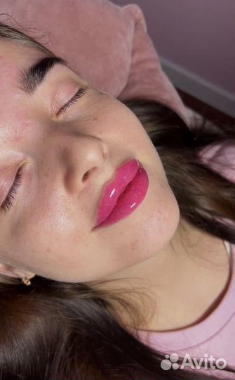 Увеличение губ / Выведение губ