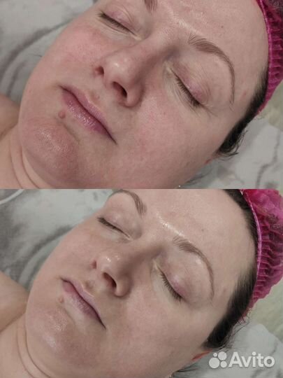 Антицеллюлитный и классический массаж