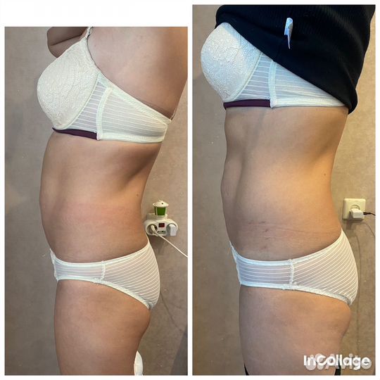 Похудение, коррекция фигуры, тейпирование тела