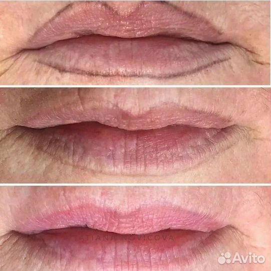 Удаление татуажа ремувером