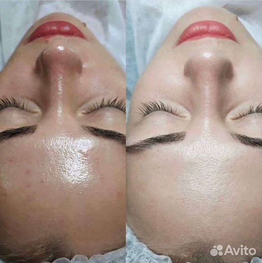 Процедура Фарфоровая куколка