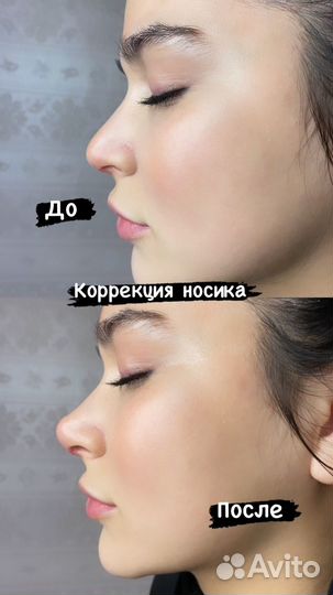 Беоперационная ринопластика
