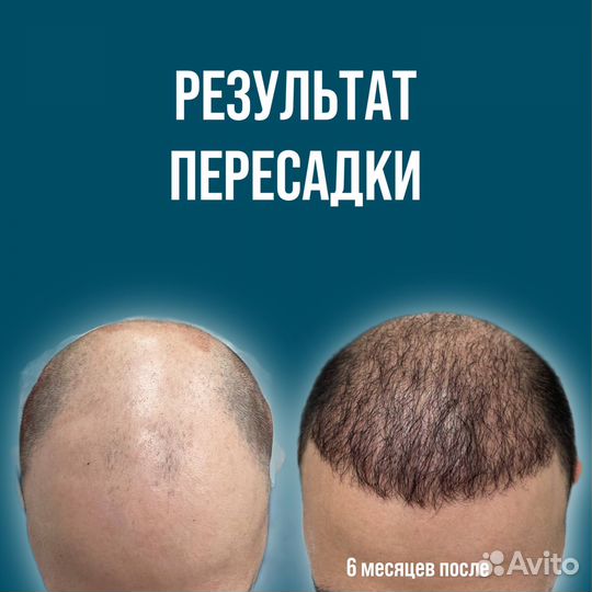 Пересадка волос современным методом