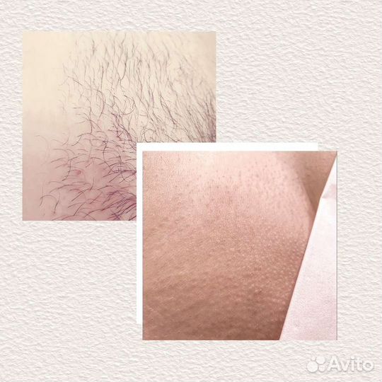 Депиляция