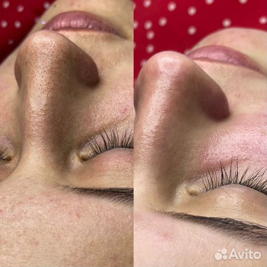 Биоревитализация