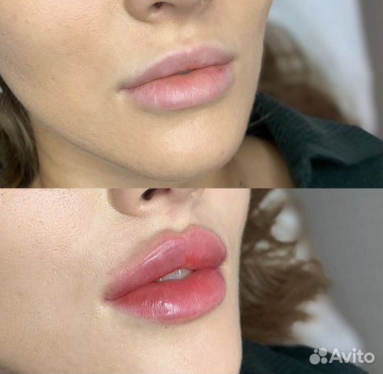 Нужны модели на процедуры по косметологии