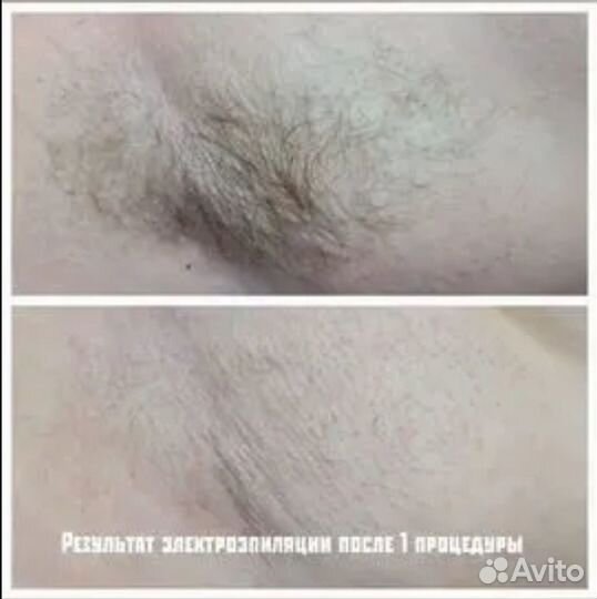 Электроэпиляция
