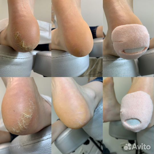 Подолог, проблемы стоп и ногтей, педикюр