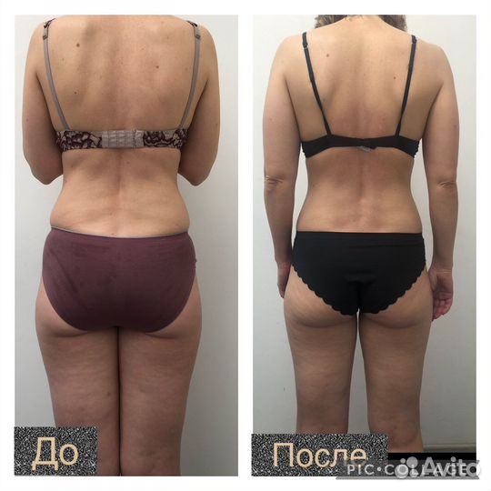 Массаж Антицеллюлитный Похудение Лучше LPG