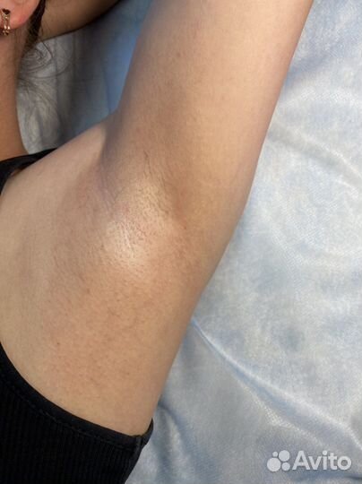 Электроэпиляция/ холодная плазма