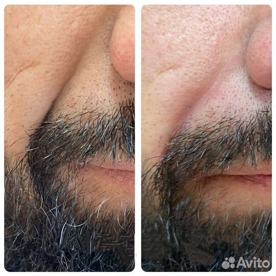 Коррекция носогубных морщин