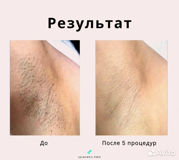 Диодный лазер Lumines Max’One 1200