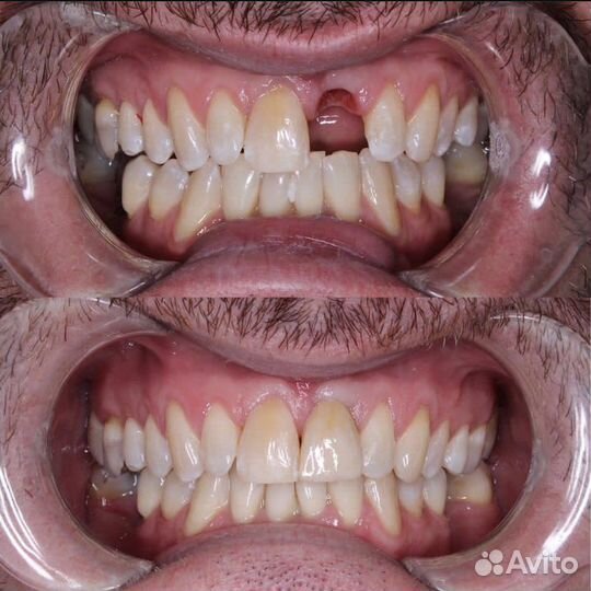 Починка зубных протезов