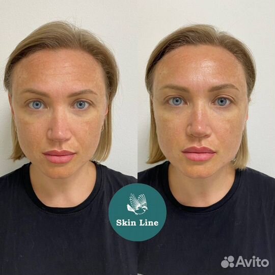 Фракционная мезотерапия/ дермапен премиум составы