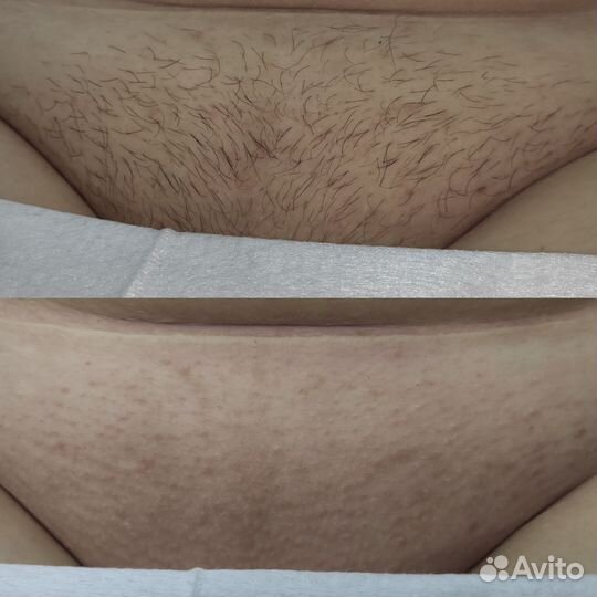 Депиляция воском и шугаринг