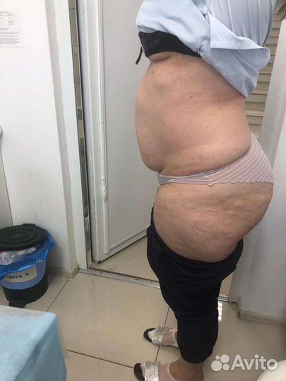 Аппаратное похудение