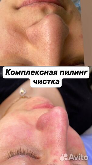 Ультразвуковая чистка лица